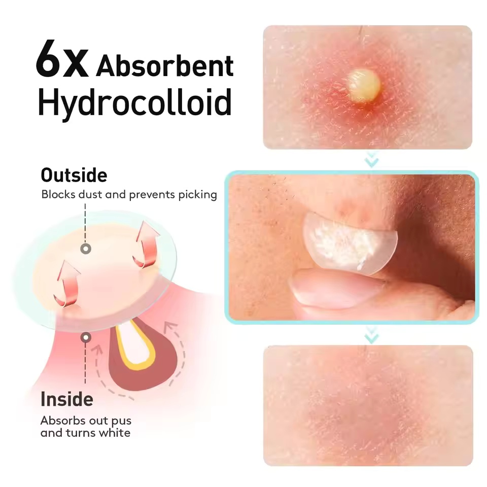 360 Stück/Karton Akne-Pflaster – Face Oil Bewertung und Preis
