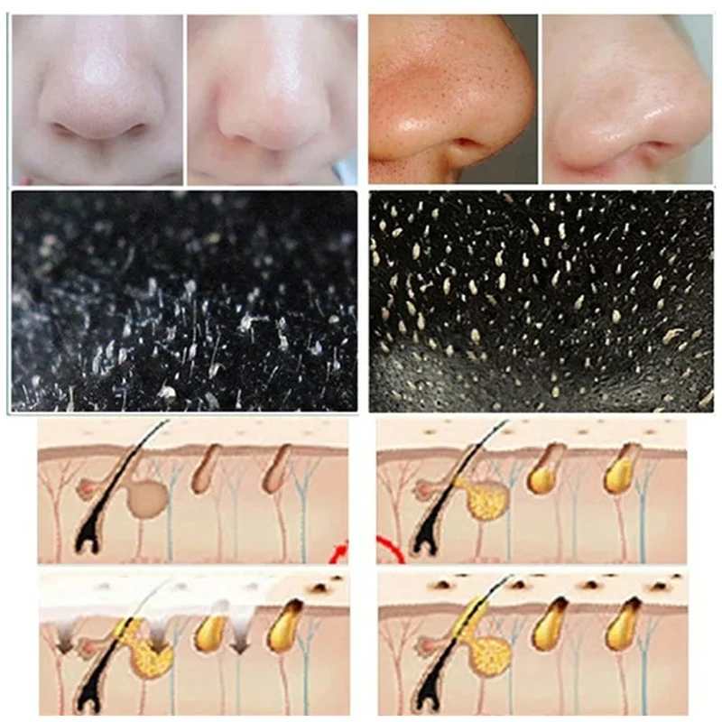 10 stücke Mitesser Nase Streif – Cleanser Face Bewertung und Preis